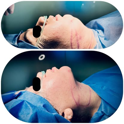 Before and After Result